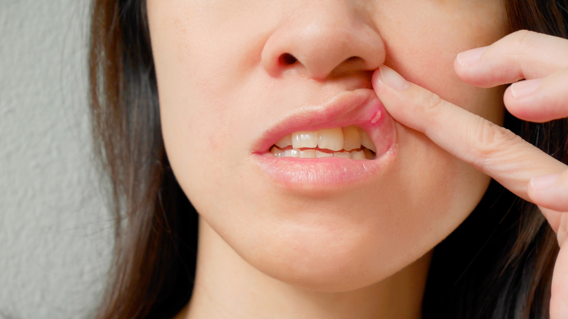 Canker Sores Mouth Ulcers And Fever Blisters Solstice Insurance